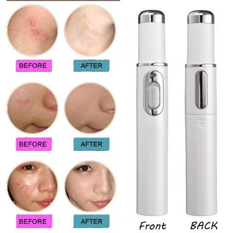  Blue Light Therapy Acne Laser Pen cashymart