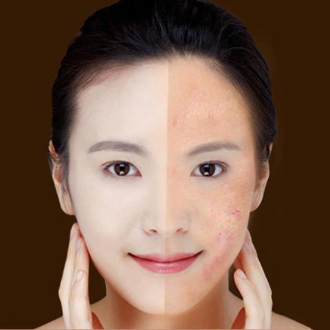  Blue Light Therapy Acne Laser Pen cashymart