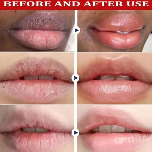  Remove Dark Lip Balm Lightening Treatment cashymart