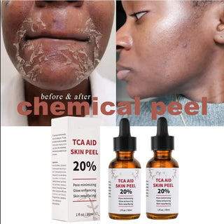  TCA Skin Peel & Pore Minimizer cashymart