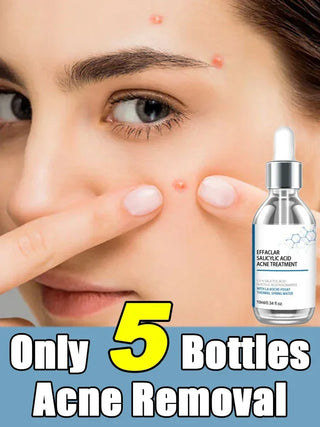  Salicylic Acid Solution Essence cashymart