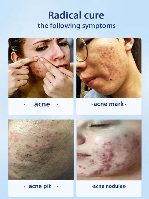  Salicylic Acid Solution Essence cashymart