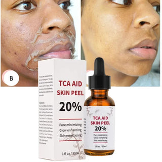  TCA Skin Peel & Pore Minimizer cashymart