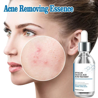  Salicylic Acid Solution Essence cashymart