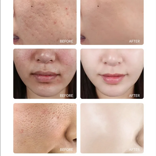  TCA Skin Peel & Pore Minimizer cashymart